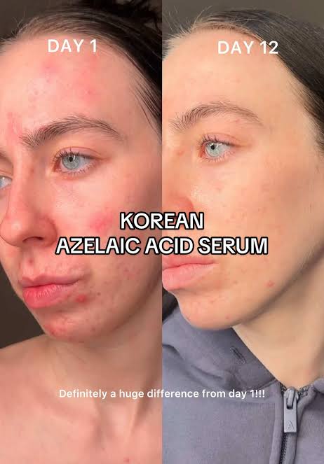 Anua Azelaic Acid 10 Hyaluron Redness Soothing Serum 30ml