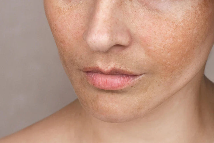 Uneven Skin Toner
